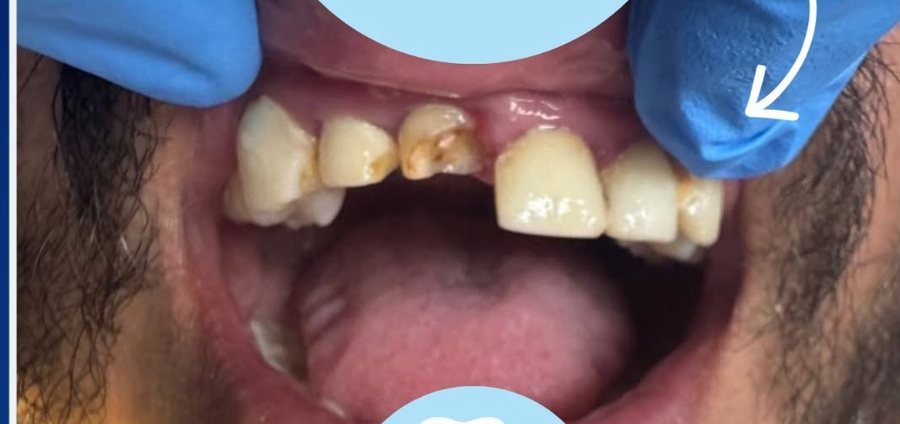 Prótesis Dental - Antes