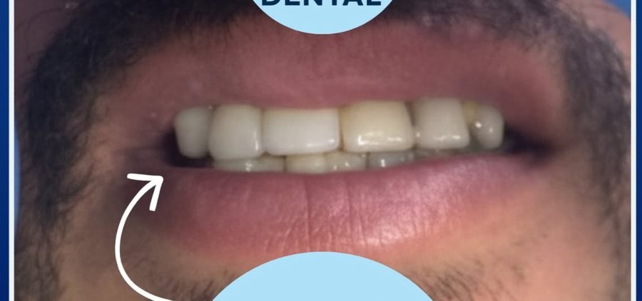 Prótesis Dental - Después