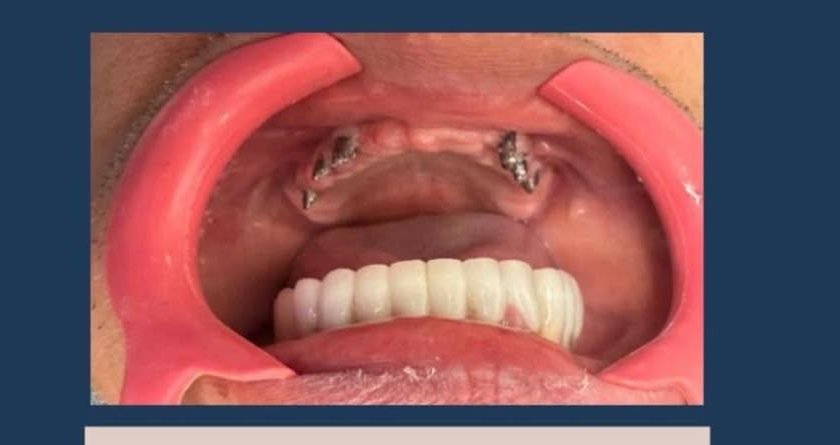 Corona de Zirconia - Antes