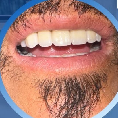 Carillas Dentales