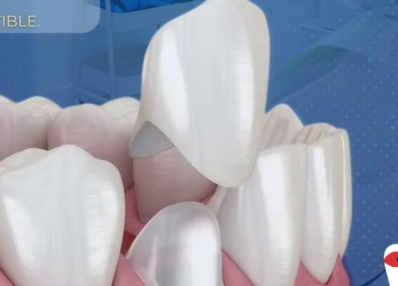 Coronas de Zirconia