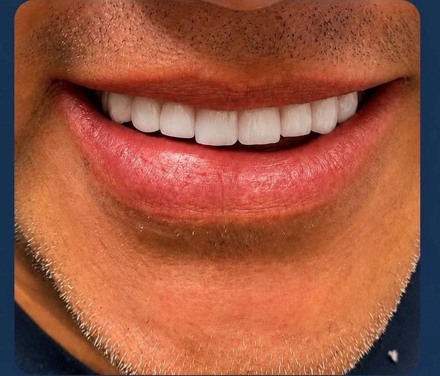 Prótesis de Zirconia